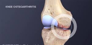 Osteoarthritis Knee