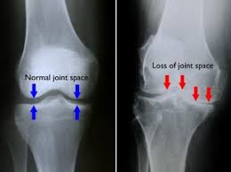 Osteoarthritis Knee