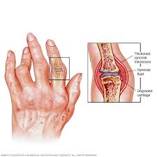 Rheumatoid Arthritis