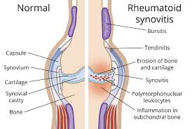 rheumatoid arthritis