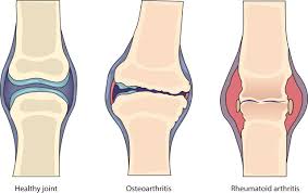 Rheumatoid arthritis