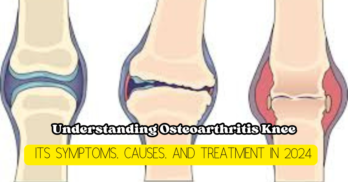 Osteoarthritis Knee