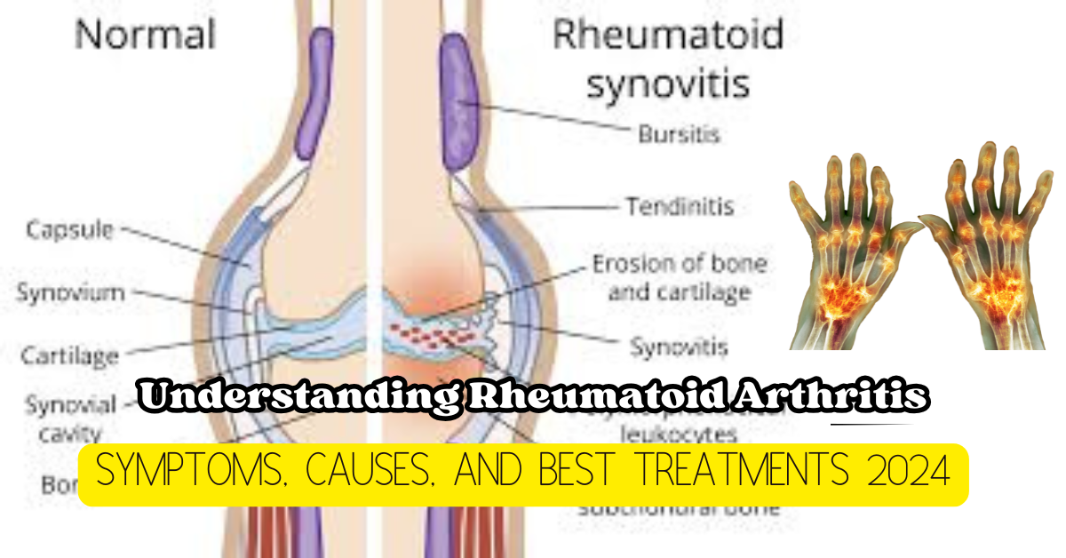 Rheumatoid Arthritis